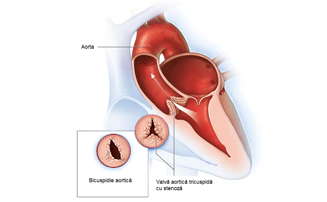 valva aortică