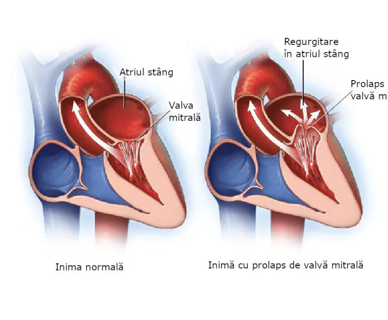 bolile valvei mitrale
