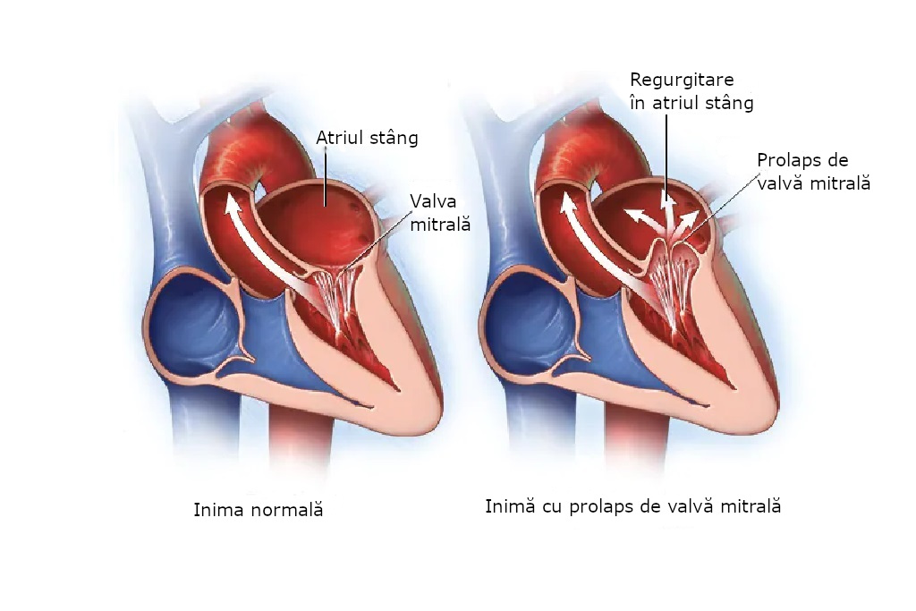 bolile valvei mitrale