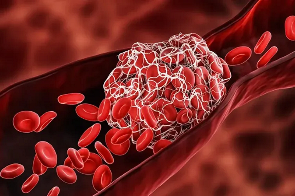 Sintrom sau Trombostop