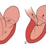 cmh, cardiomiopatie hipertrofica