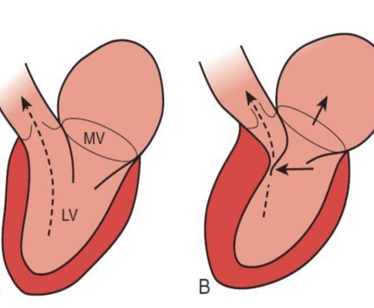 cmh, cardiomiopatie hipertrofica