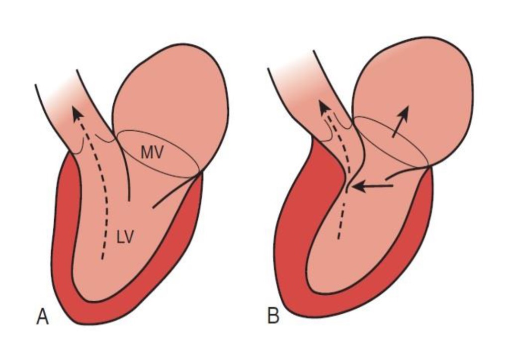 cmh, cardiomiopatie hipertrofica